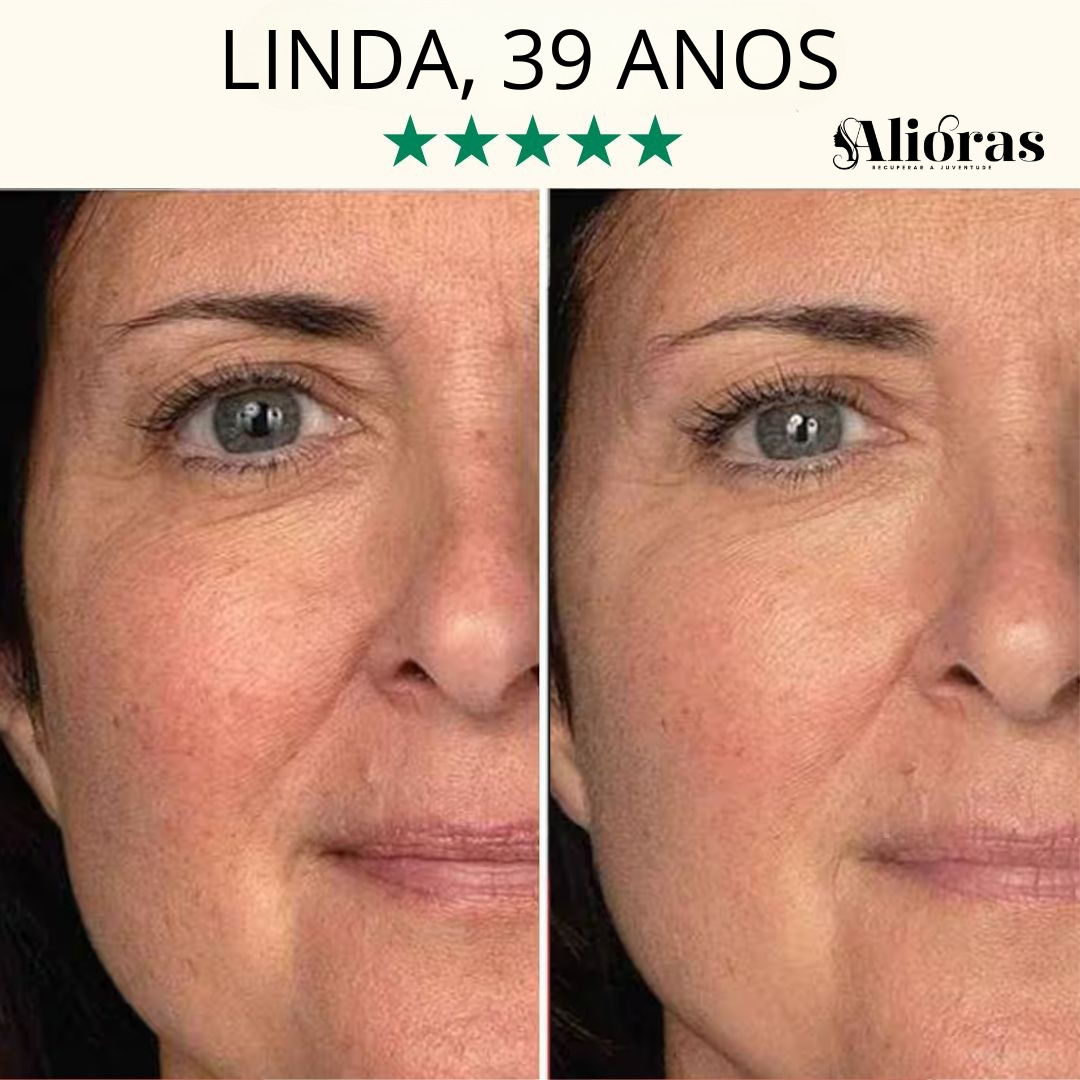 LumaLift™ - Lifting e Anti-Envelhecimento